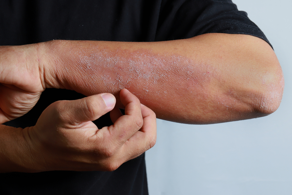 How to Relieve that Itch Without Scratching