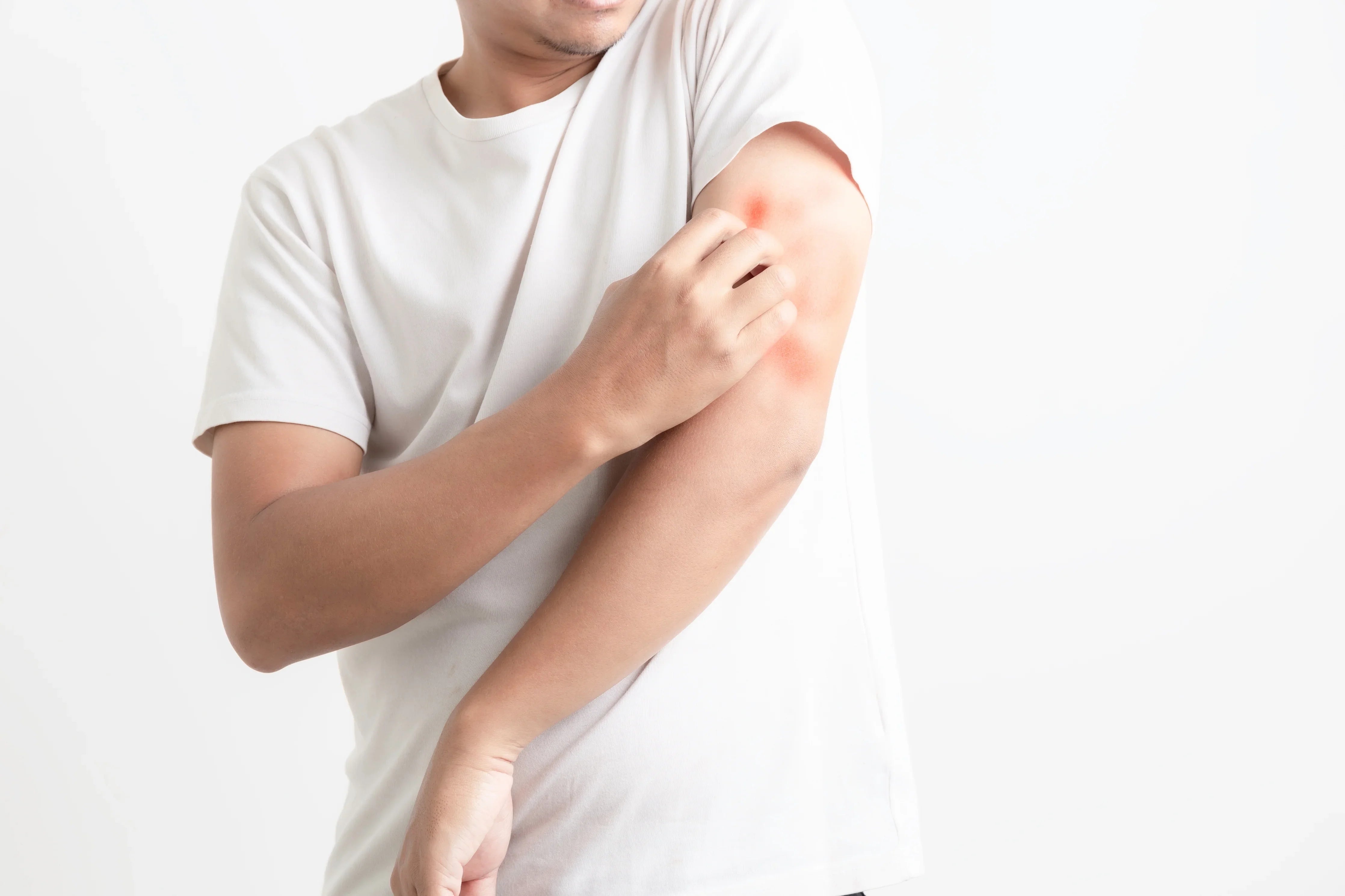 Man scratching red irritated arm from clothing allergy, wearing white hypoallergenic shirt