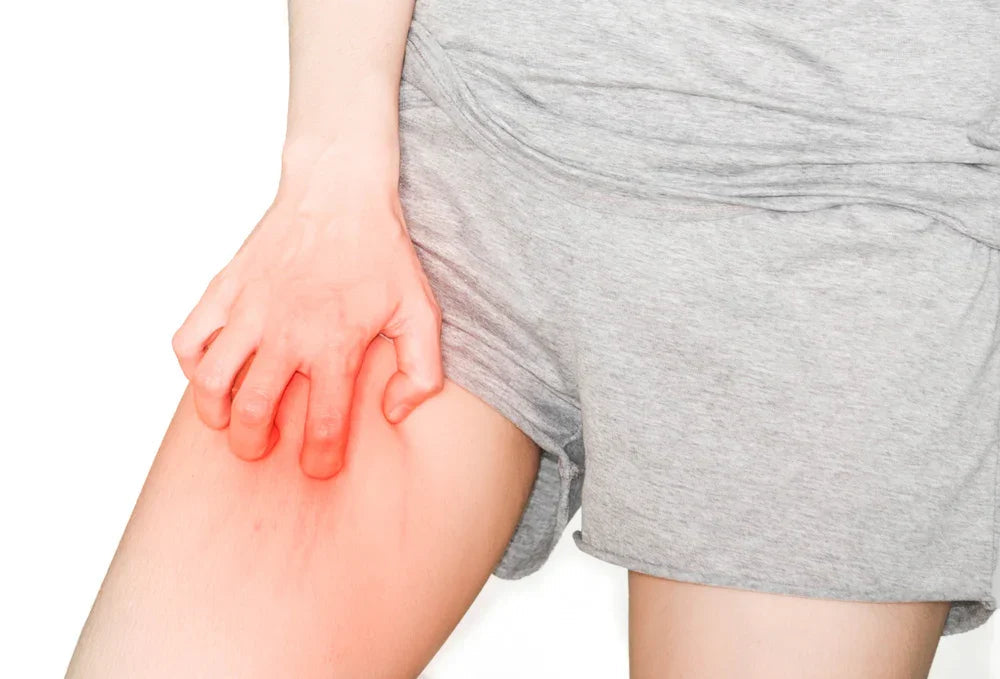 Person scratching red, irritated skin on thigh while wearing light gray shorts, eczema concept