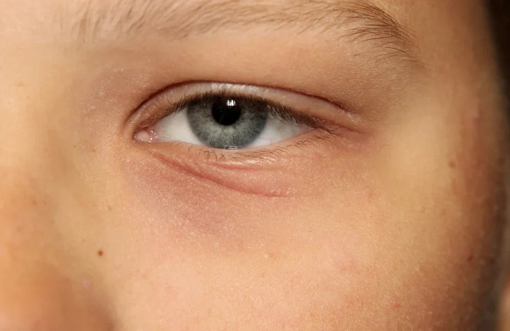 Close-up of blue eye and sensitive skin, highlighting irritation and eczema-prone skin
