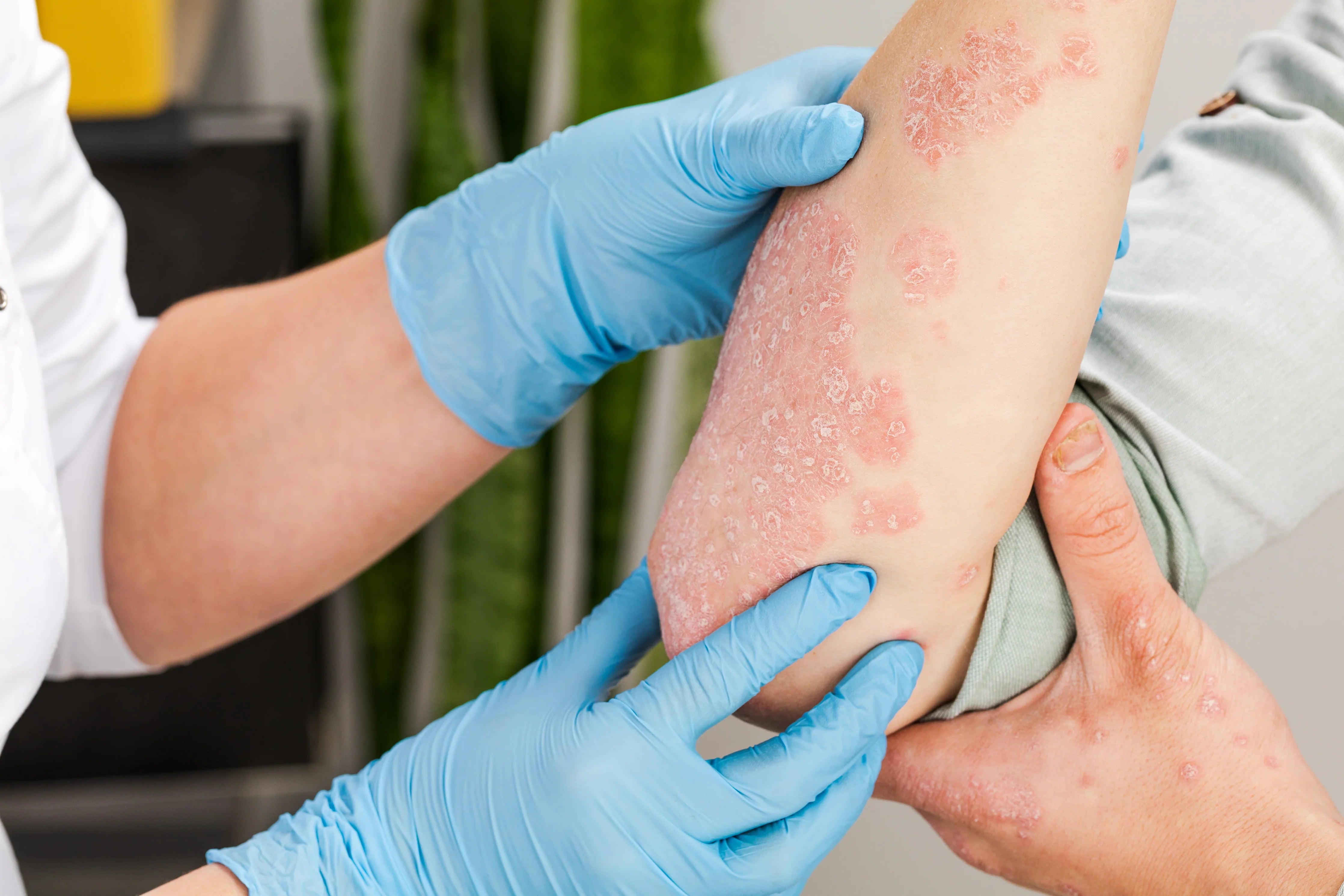 Dermatologist examining red, flaky skin rash on person's arm, symptoms of sensitive skin condition