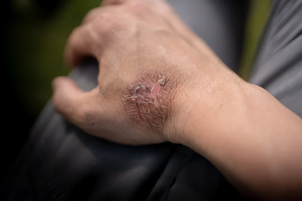 Hand with dry, irritated eczema skin, showing redness and flaking.