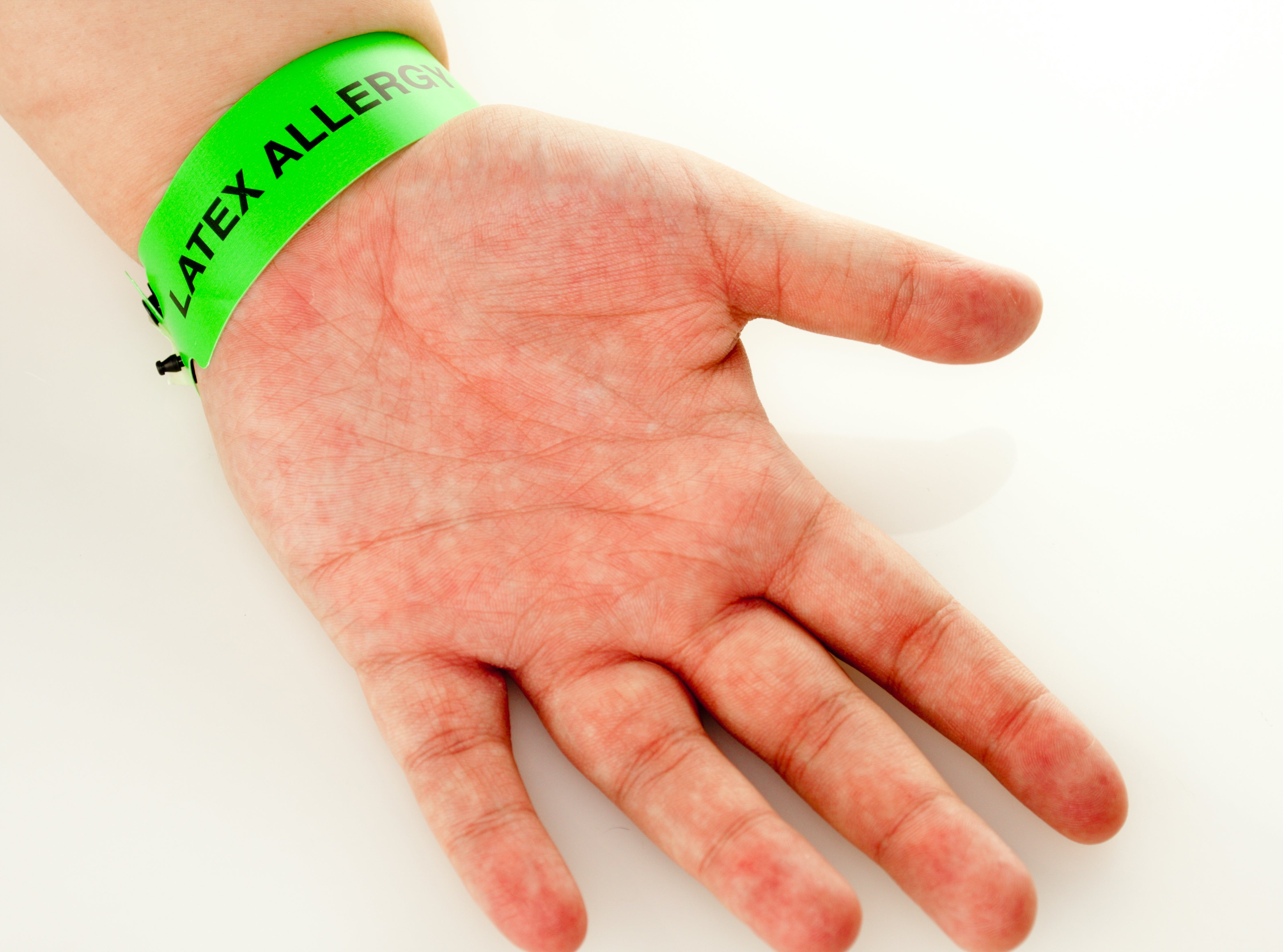 The 5Ws of Latex Allergy