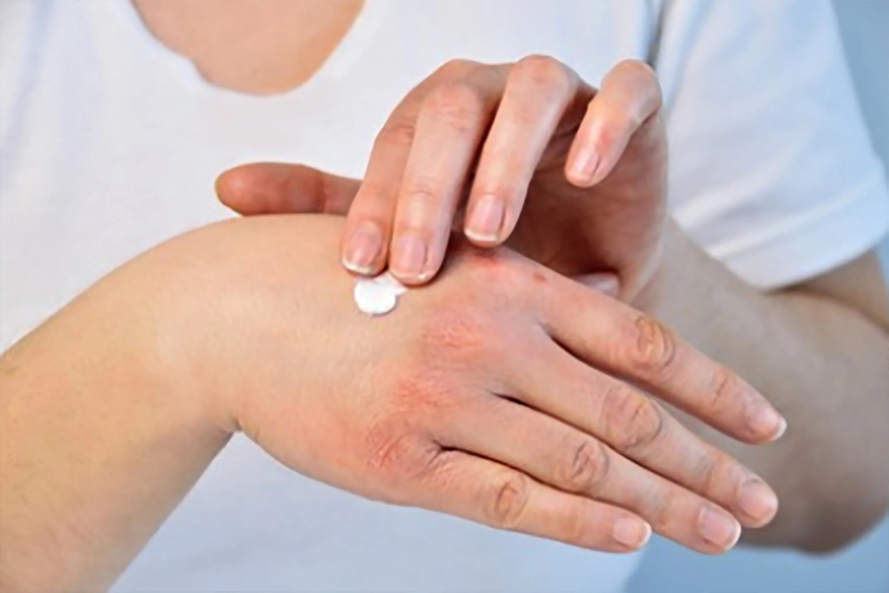 Person applying hypoallergenic lotion to red irritated skin on hand, allergy-free skincare