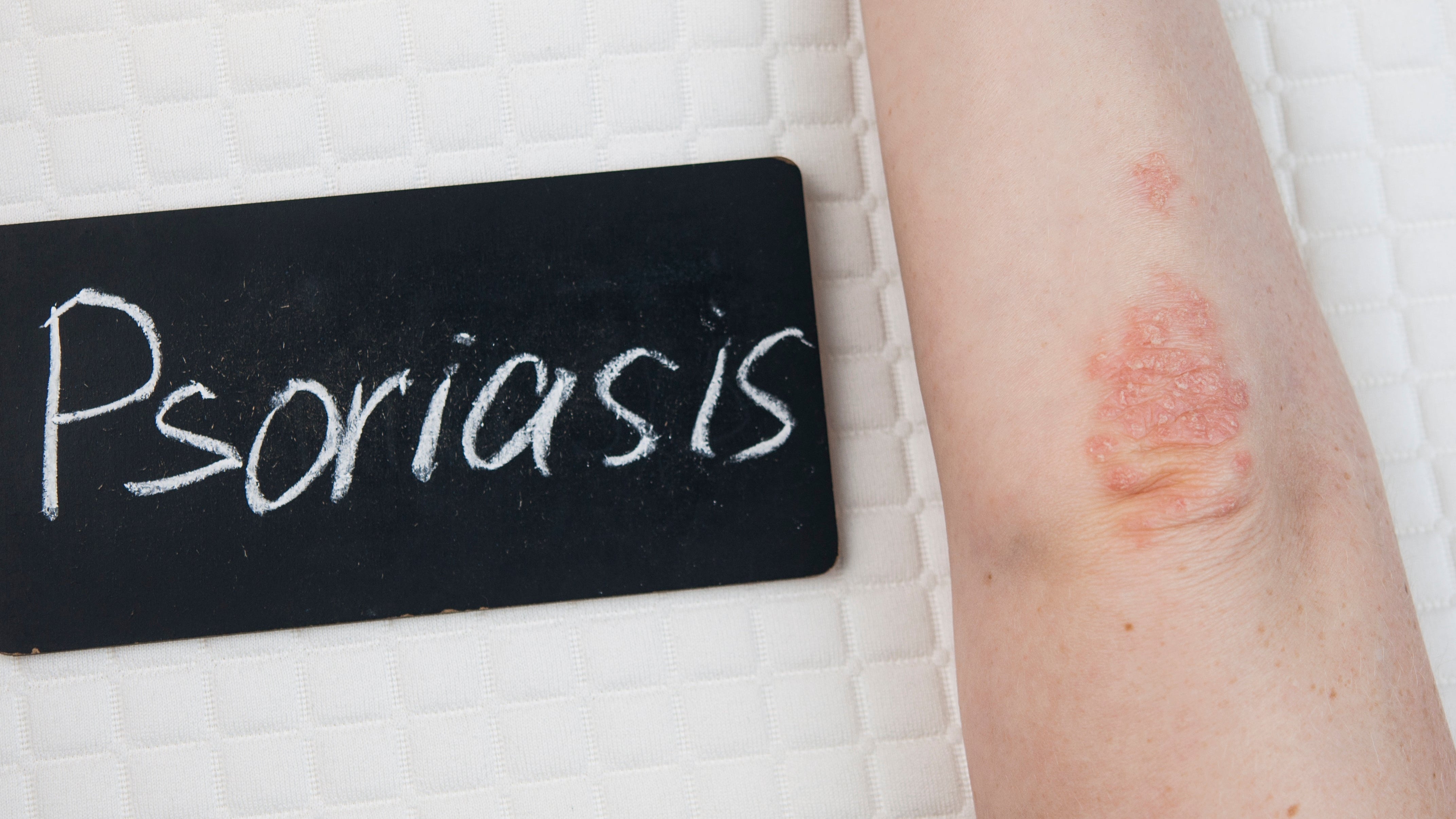 Psoriasis Awareness Month: How Clothing Choices Can Help Support Your Daily