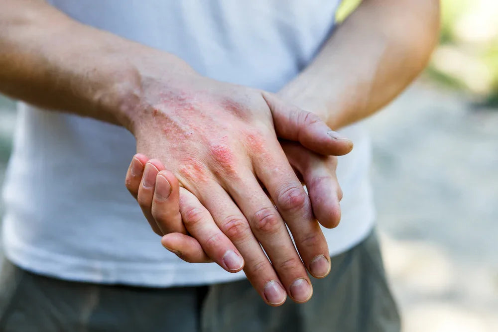 Close-up of hands with skin irritation, highlighting allergy to clothing fabrics outdoors