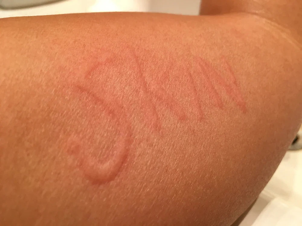 Close-up of an arm with red skin irritation and the word 'SKIN' marked on it
