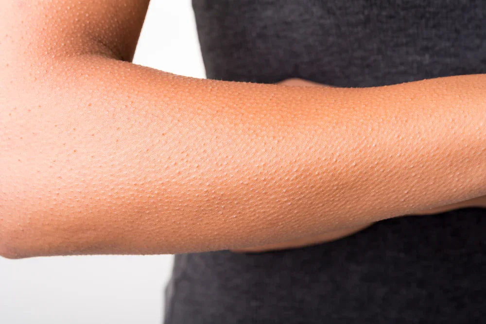 Close-up of an arm with goosebumps, highlighting skin sensitivity and allergy concerns