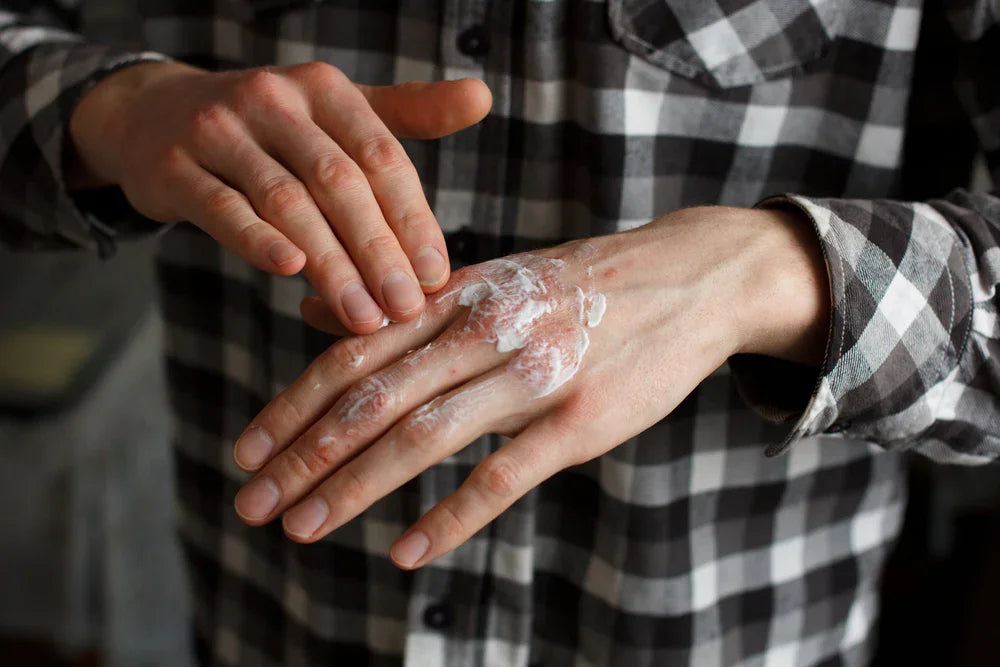 Man applying moisturizer to hands for eczema and sensitive skin relief