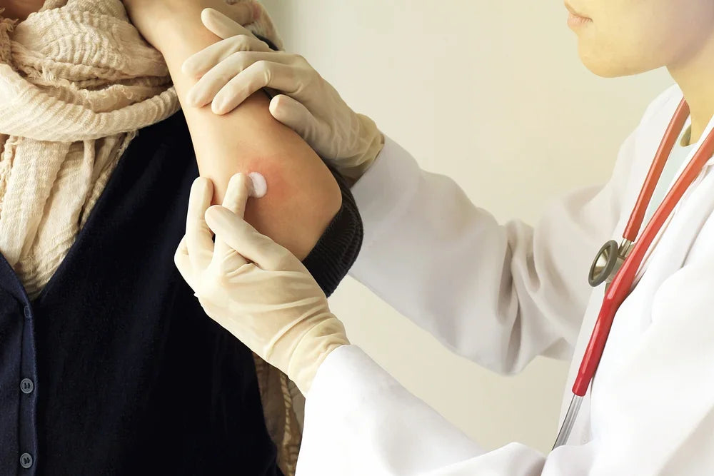 How to Prevent Eczema? Stop it Before it Happens