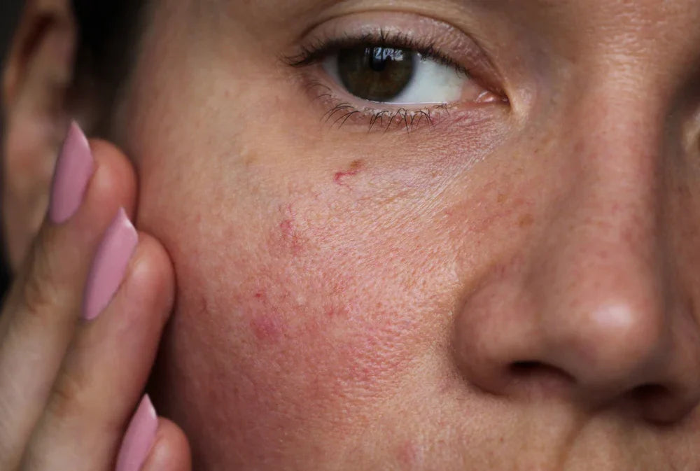 Close-up of woman with irritated, red, allergy-prone skin on cheek, highlighting sensitive skin.