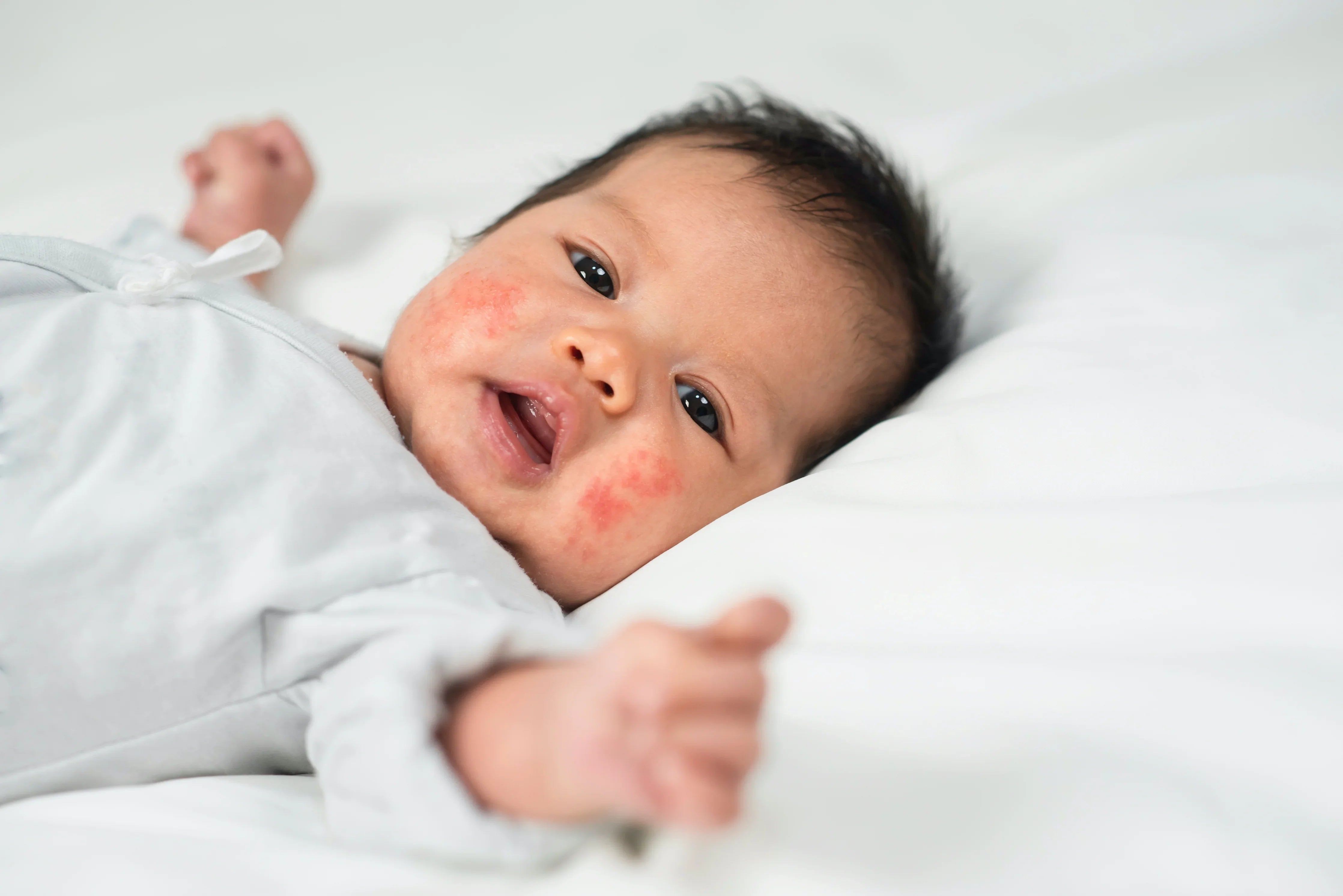 Baby with eczema on cheeks lying on soft white bedding, wearing gentle cotton clothing