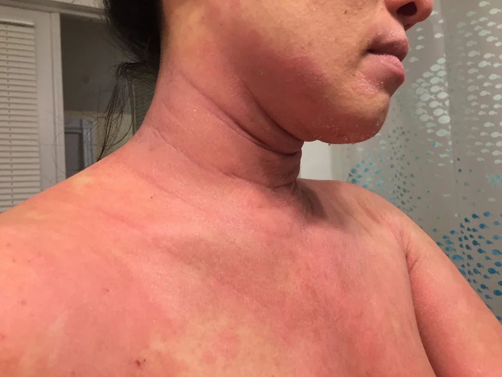 Close-up of woman with red irritated skin on neck, chest, and jaw, showing eczema symptoms