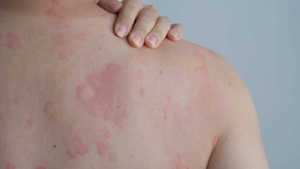 Person with red eczema patches and irritated skin on back, sensitive skin condition