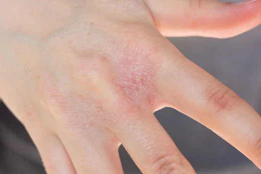 Hand with red, irritated skin showing eczema symptoms, suitable for sensitive skin topics