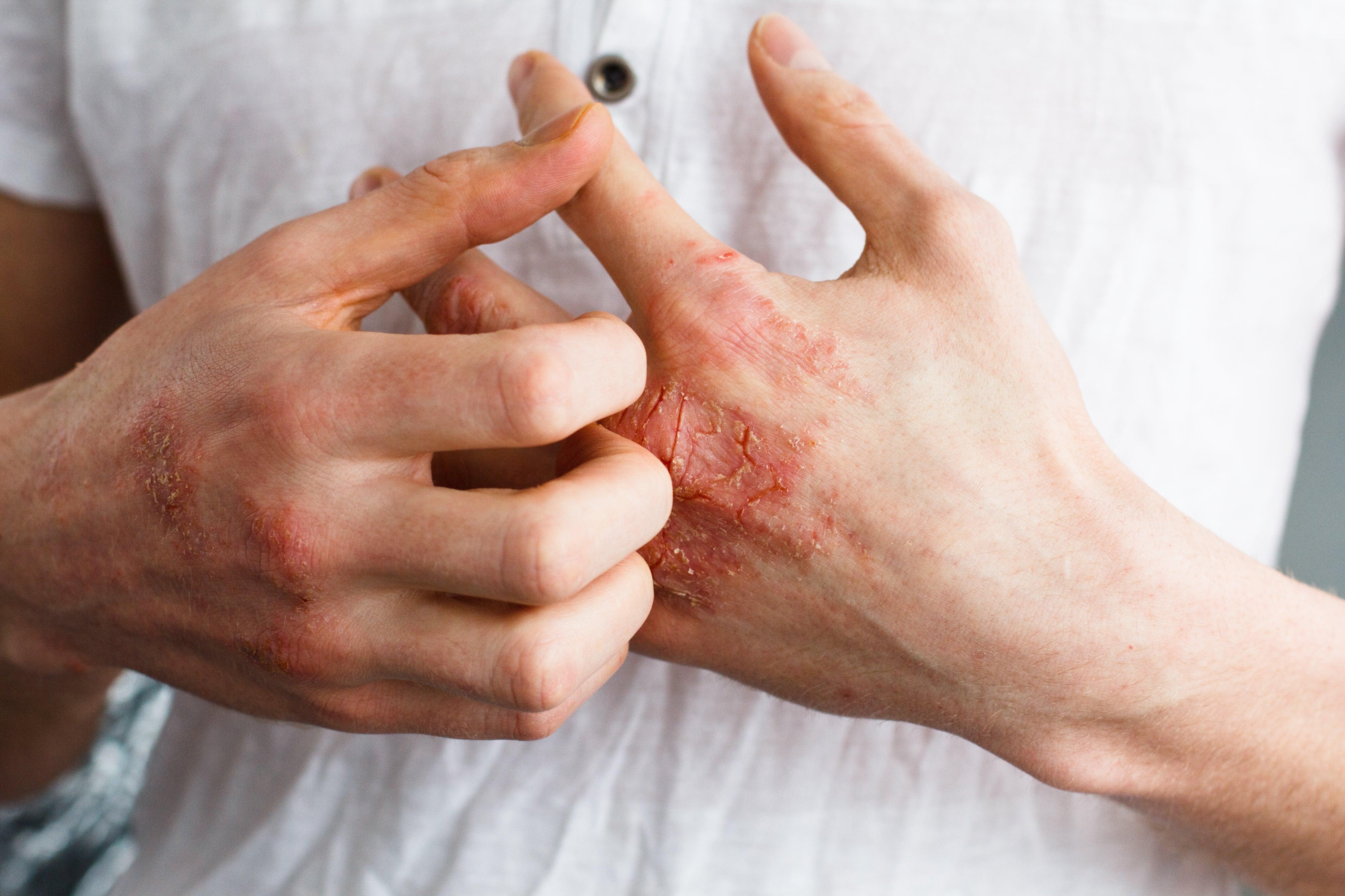Close-up of person scratching red, irritated skin on hand, possibly from clothing allergy